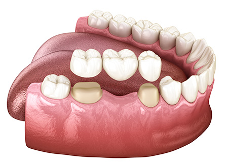 种植牙和镶牙有什么区别？哪种修复方式更好？