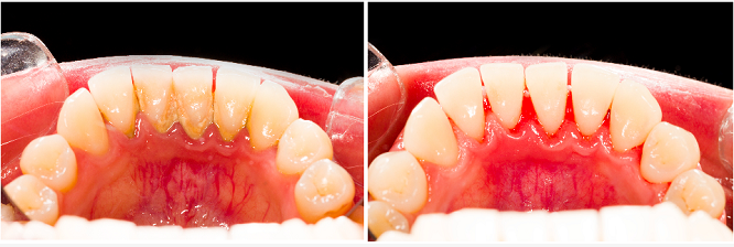 洗牙会损坏牙齿、导致牙齿敏感、牙缝增大吗？