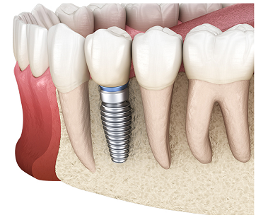 补牙、镶牙和种植牙有什么区别？