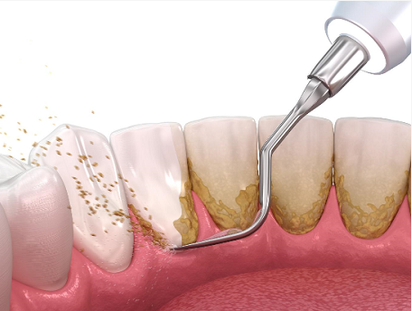 洗牙会损坏牙釉质吗？