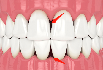 两颗相邻的牙齿之间多了个黑三角是怎么回事？