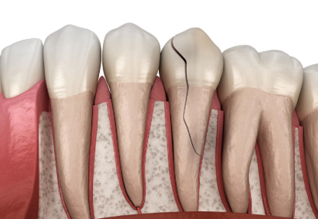 什么情况会导致牙齿敏感？
