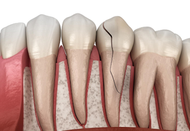 牙隐裂有什么危害？