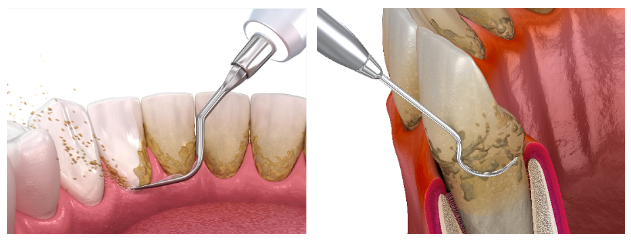 牙结石对口腔有什么危害？