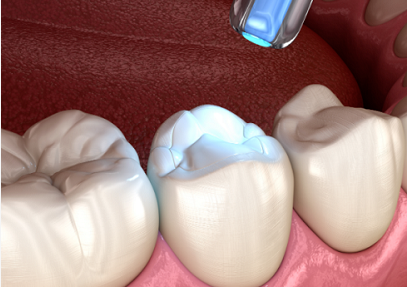 补牙、镶牙和种植牙有什么区别？