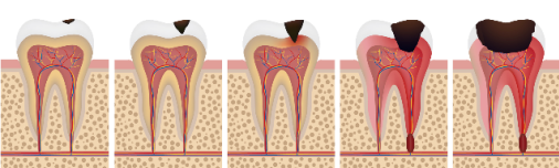 蛀牙会导致牙齿丧失，你的蛀牙处于哪个阶段？