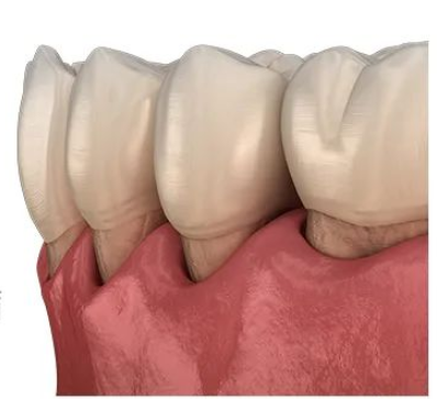 牙龈萎缩到底有多可怕？