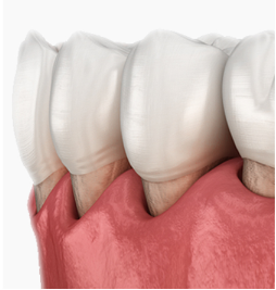 牙龈萎缩可以恢复吗？怎么预防和控制牙龈萎缩？