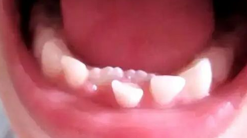 孩子的乳牙什么情况下需要拔除？