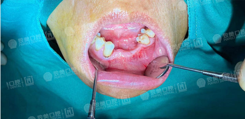 种植牙术前需要做哪些检查？