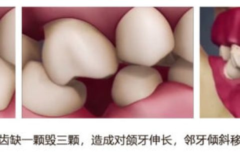 缺一颗牙不修复，有危害吗？