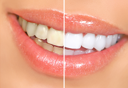 牙齿美白方法，你选对了吗？