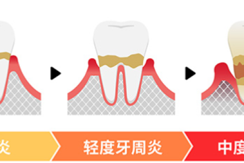 什么是牙周病？牙周病有什么症状？