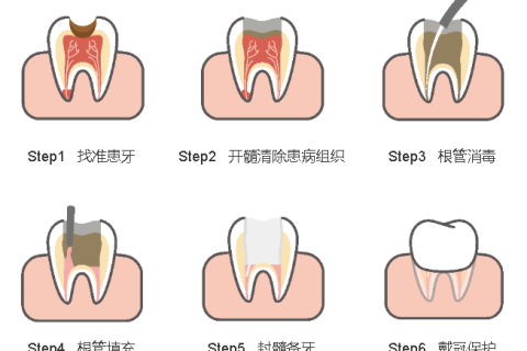 什么是根管治疗？