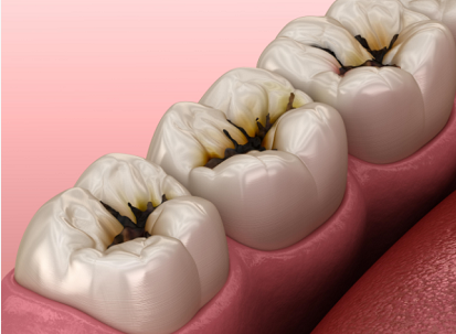 牙齿敏感酸痛是怎么回事？