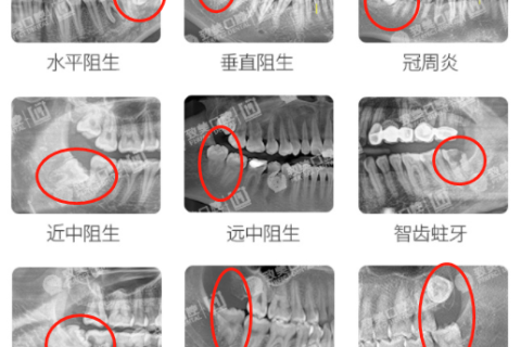 智齿一定要拔吗？拔智齿会不会影响脸型？