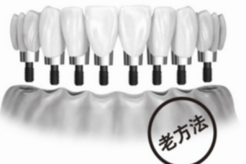 全口缺牙是要种植28颗牙吗？