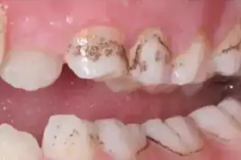 孩子牙齿有黑黑的东西是什么？