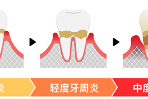 警惕！牙周病，终致牙齿松动、脱落