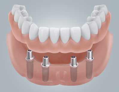 半口/全口牙齿缺失了怎么办？牙槽骨萎缩怎么办？ 还能种植牙吗？