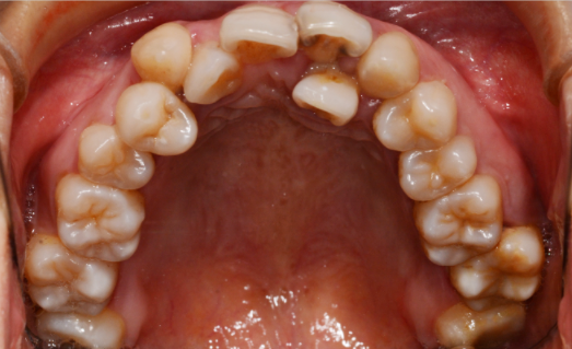 牙齿拥挤是什么原因造成的？不矫正会有什么危害？