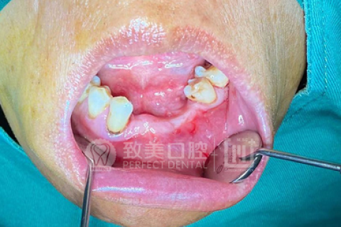 为什么有些人种牙需要植骨？植骨用的骨粉、骨膜又是什么？
