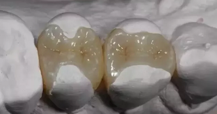 牙齿被蛀一大半怎么办？嵌体是个不错的选择