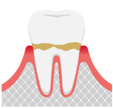 牙周病是如何一步步导致牙齿脱落的