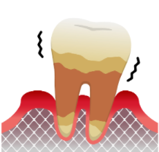 牙周病是如何一步步导致牙齿脱落的
