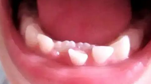 孩子乳牙出现哪些情况需要拔除？不拔会有什么危害？