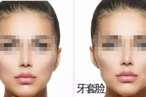 牙齿矫正会出现牙套脸？