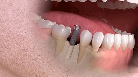种植牙的利弊有哪些？