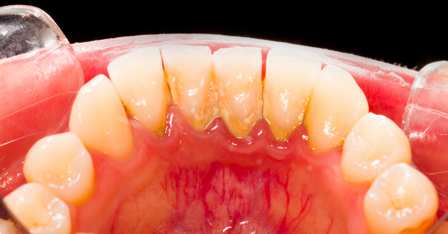 牙菌斑和牙结石长什么样？有什么危害？怎么办？