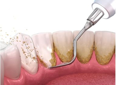 牙菌斑和牙结石长什么样？有什么危害？怎么办？