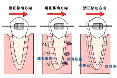 牙齿矫正会导致牙齿松动吗？