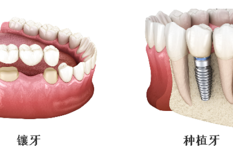 拔牙后镶牙好还是种牙好？
